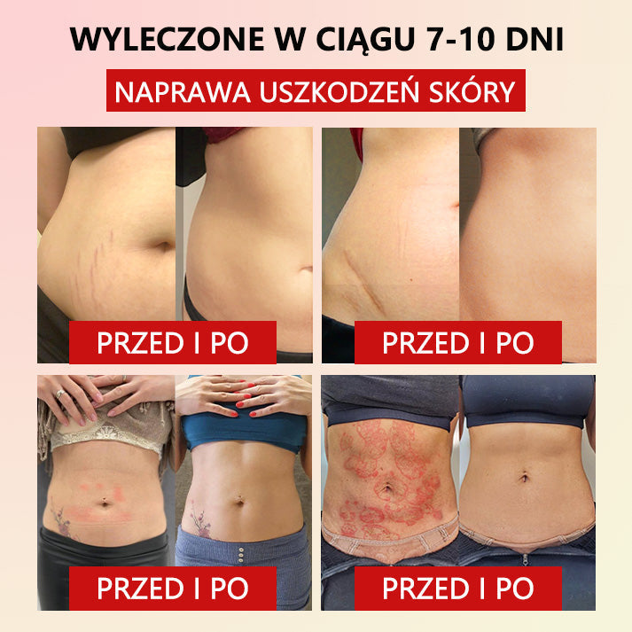 mikrovibrációs féreghajtás erősítő öv a Ciała❤️ formázásához (plasztikai sebészek által ajánlott)