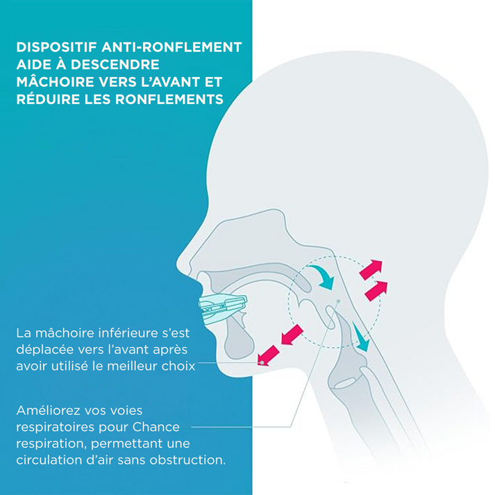 Rugalmas és alkalmazkodó ortézis horkolás és alvási apnoe ellen