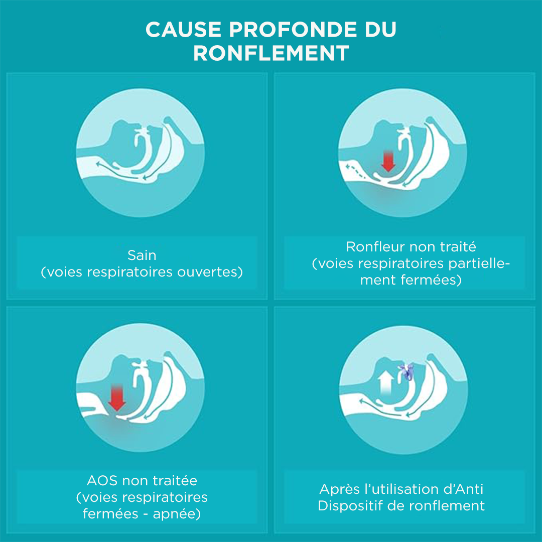 Rugalmas és alkalmazkodó ortézis horkolás és alvási apnoe ellen