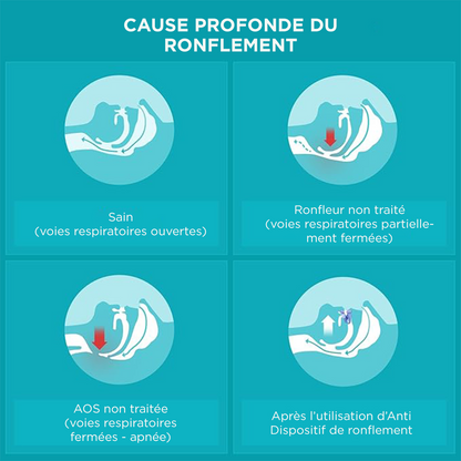Rugalmas és alkalmazkodó ortézis horkolás és alvási apnoe ellen